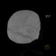 Intraparietal suture, accessory suture: CT - Computed tomography